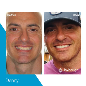 invisalign-turkey-(15)
