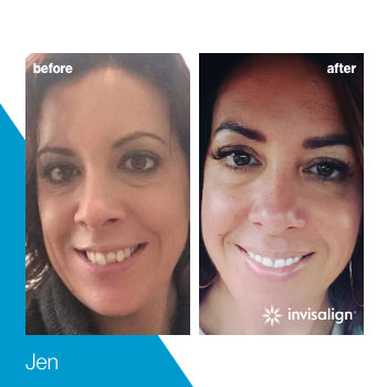 invisalign-turkey-(16)