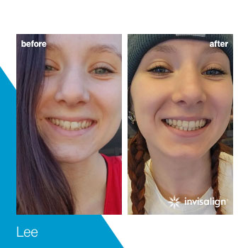 invisalign-turkey-(3)