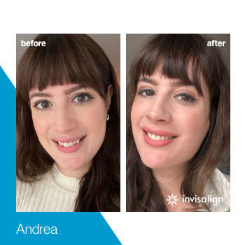 invisalign-turkey-(9)